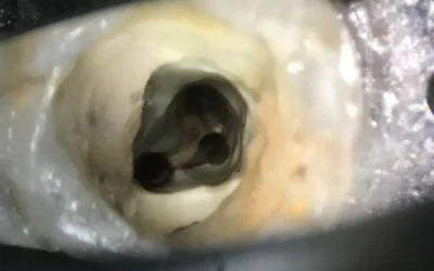 Danger zone in C-shaped root canals